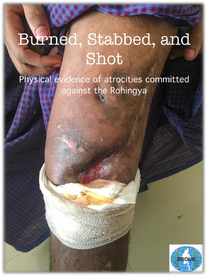 Press Release:Burned, Stabbed and Shot– Physical Evidence of Atrocities Committed against the Rohingya